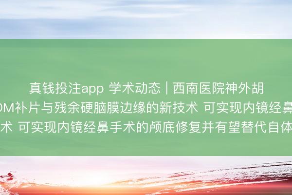 真钱投注app 学术动态 | 西南医院神外胡荣团队报道缝合打结ADM补片与残余硬脑膜边缘的新技术 可实现内镜经鼻手术的颅底修复并有望替代自体移植物